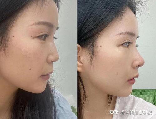 杭州整容爆料案件最新情况,真相逐步浮出水面  第2张